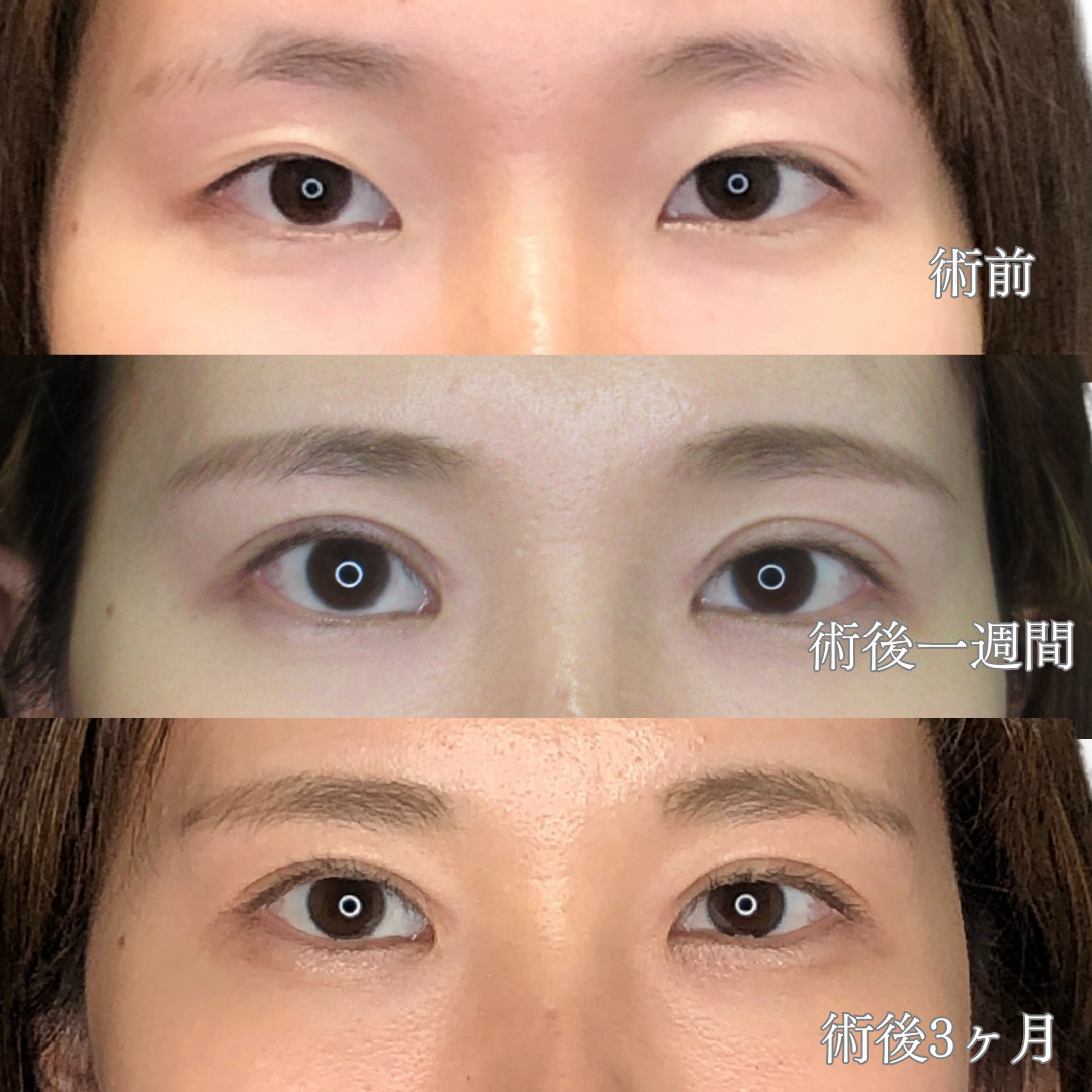 20代後半女性｜鈴木Dr.による二重全切開術で左右対称かつ自然な平行二重を実現
