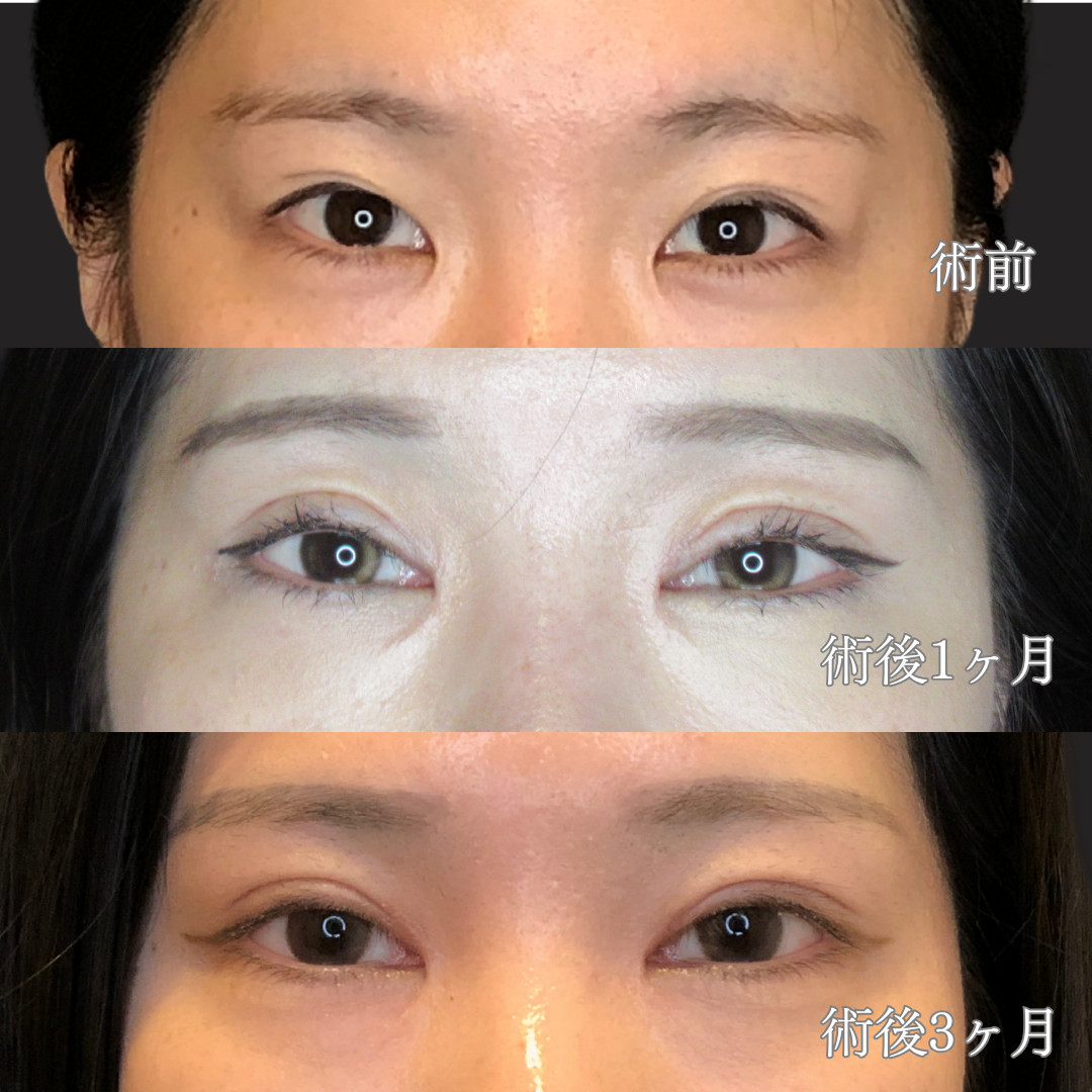 20代後半女性｜二重全切開＋目頭切開で華やかな末広二重を実現