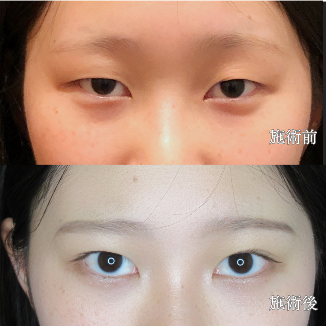21歳女性｜二重埋没P-PL挙筋法 LONGで重め一重から自然な末広二重を実現