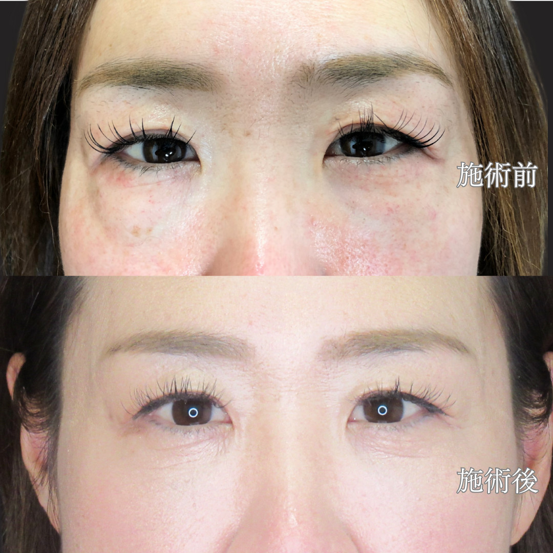 30代後半女性｜経結膜脱脂で“疲れ顔”解消