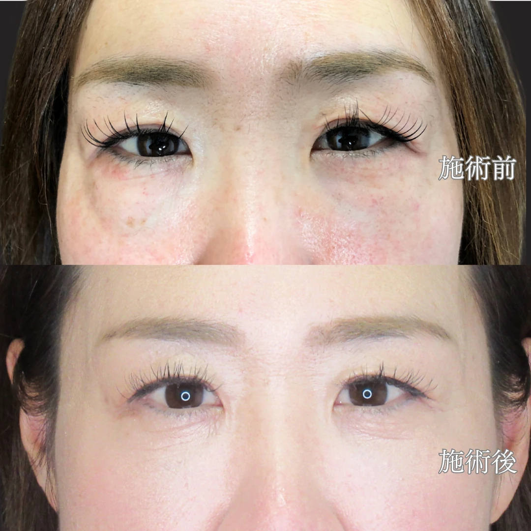 30代後半女性｜経結膜脱脂で“疲れ顔”解消