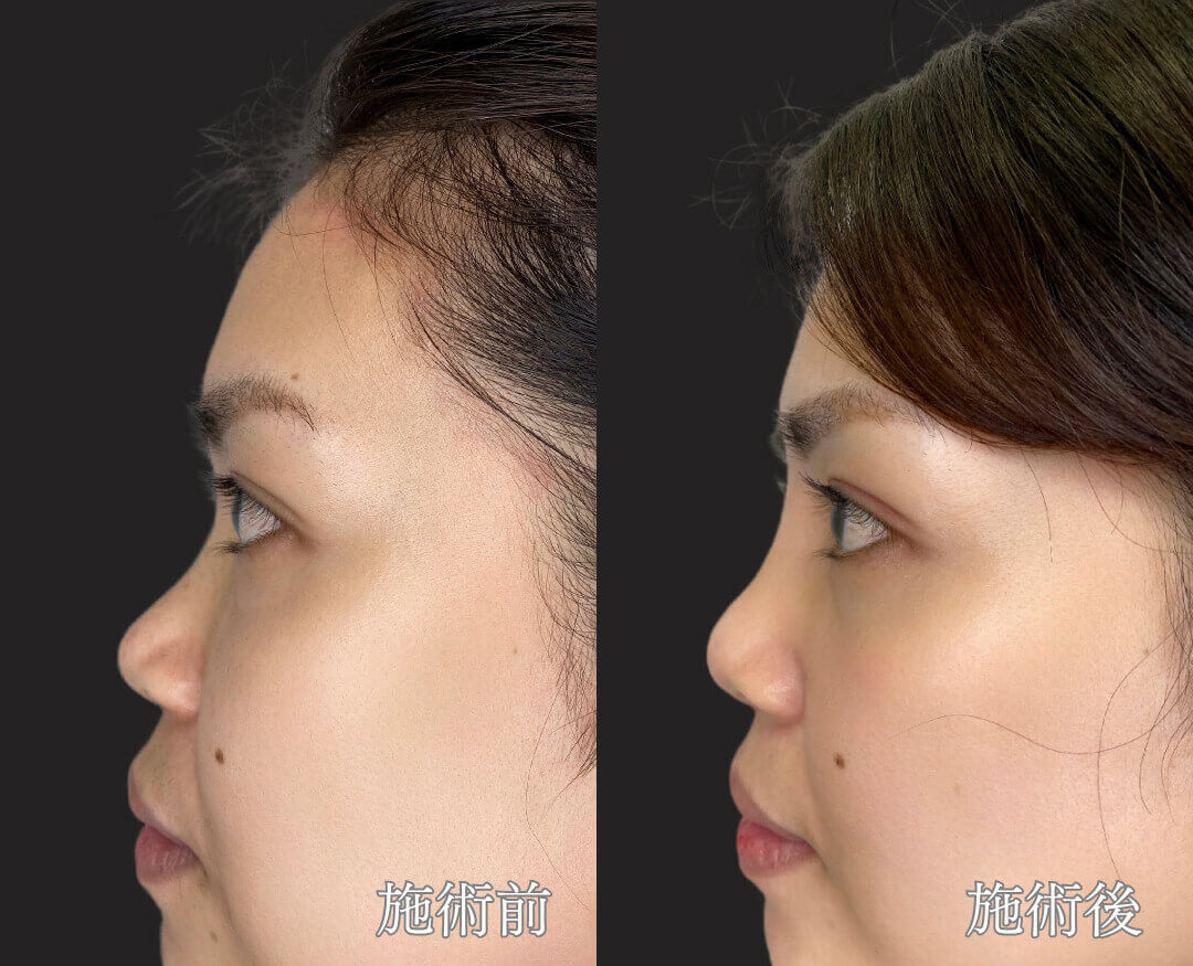 30代女性、鼻筋を通して立体感のある横顔を鼻プロテーゼで実現