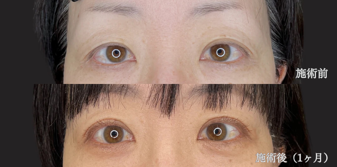 46歳女性｜二重埋没法で自然な二重再固定