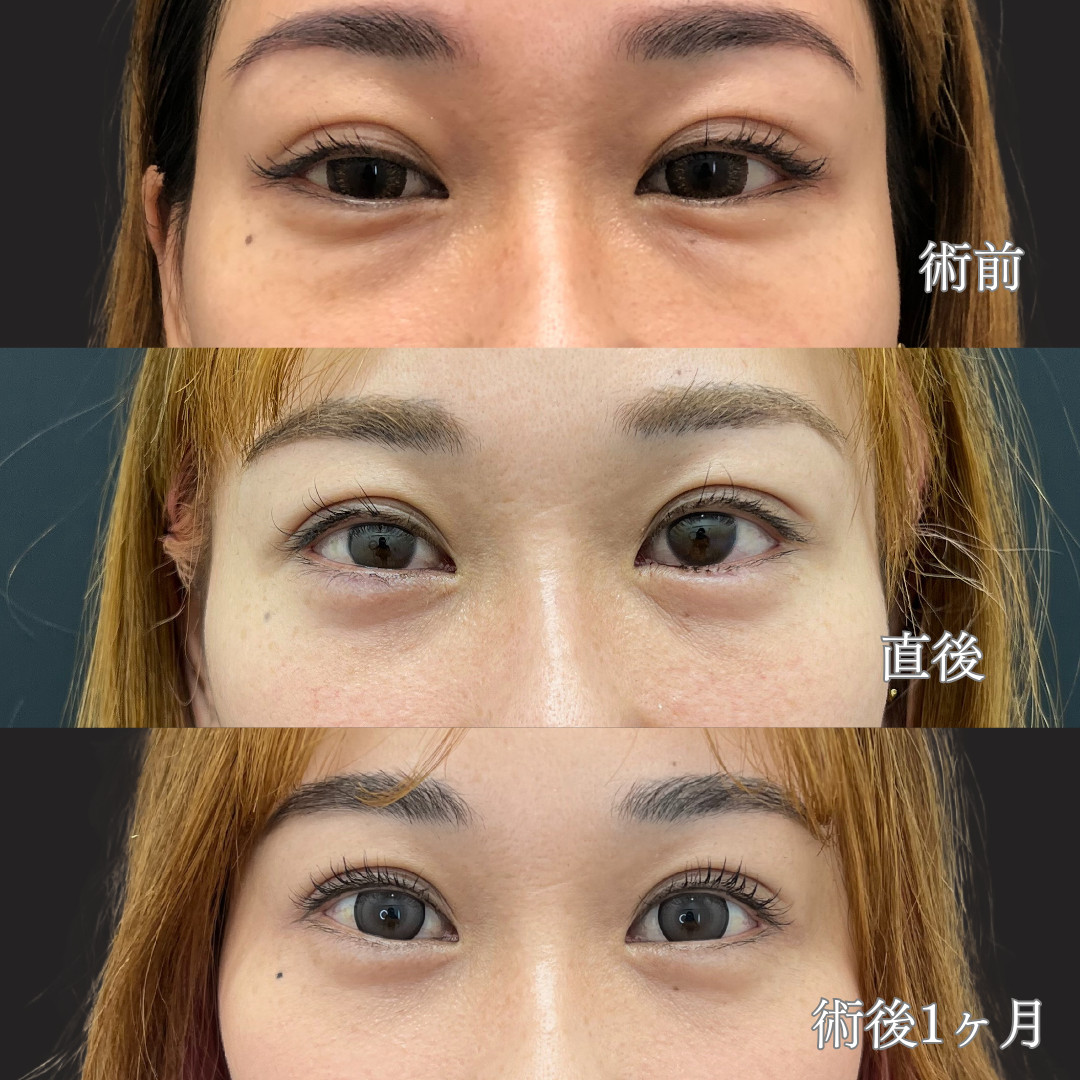 30代前半女性｜経結膜脱脂で自然な涙袋を形成