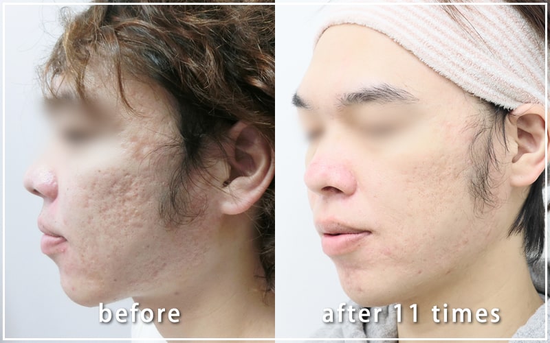 治療経過写真04