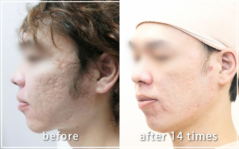 治療経過写真05