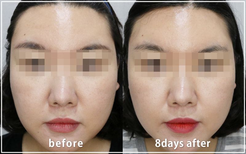 bnlsの症例写真　ケース2