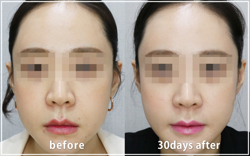 bnlsの症例写真　ケース7