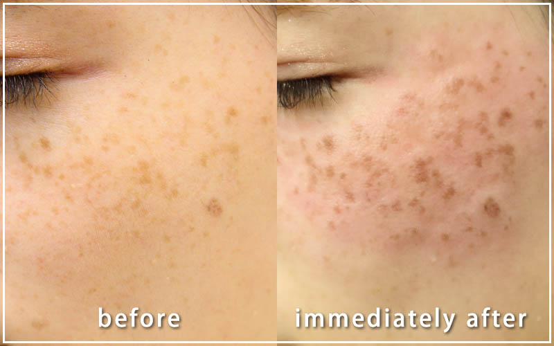 しみ取りレーザーの症例　左側 直後