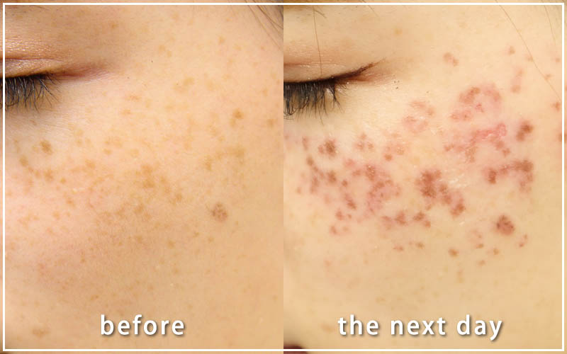 しみ取りレーザーの症例　左側 翌日