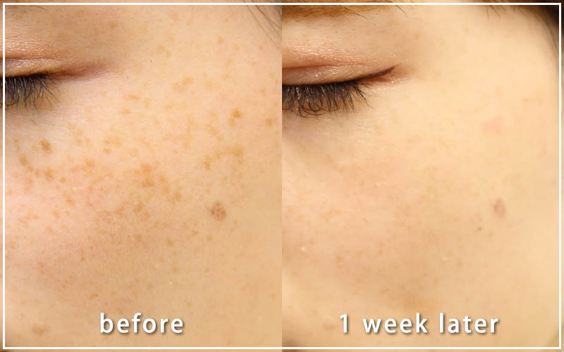 しみ取りレーザーの症例　左側 1週間後