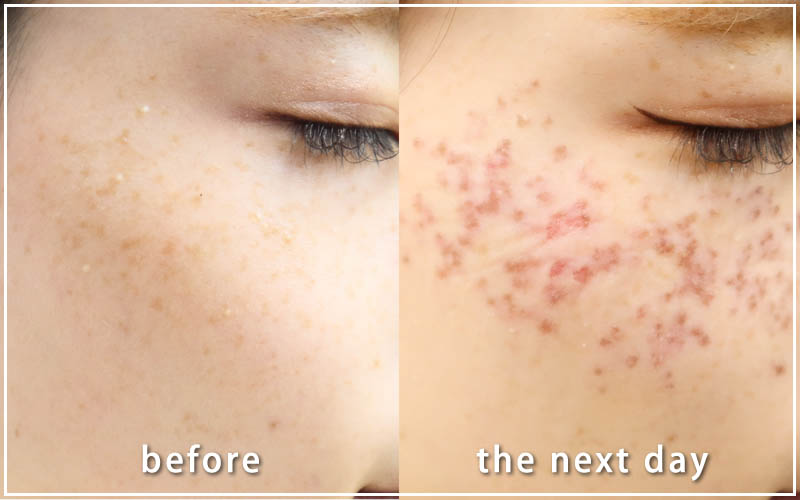 しみ取りレーザーの症例　右側 翌日