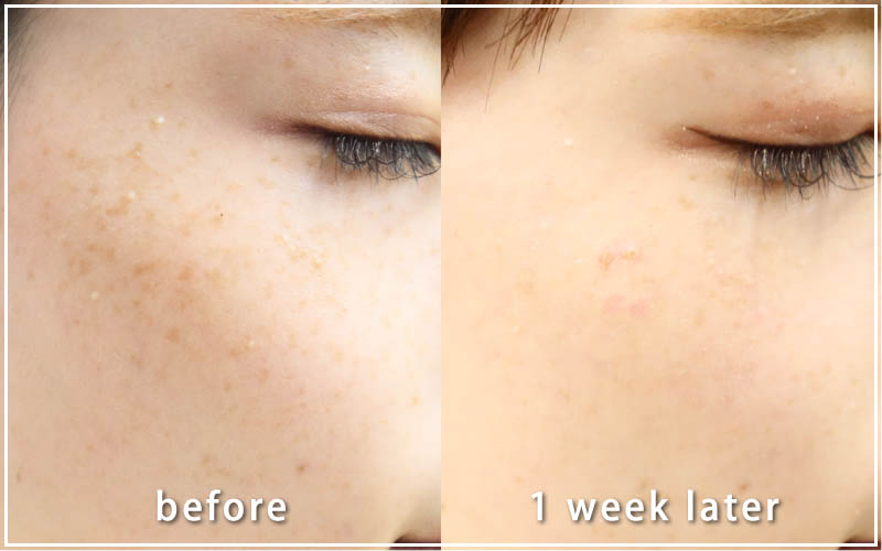 しみ取りレーザーの症例　右側 1週間後