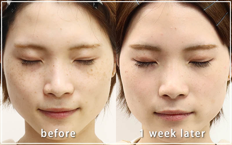 しみ取りレーザーの症例　正面 1週間後